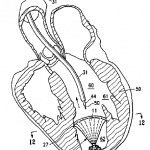 Heart Failure Technologies Seeks Inter Partes Review of CardioKinetix Patent