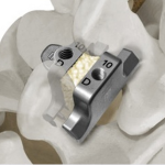 Southern Spine Announces 2015 MDEA Honor for StabiLink® MIS Spinal Fixation System