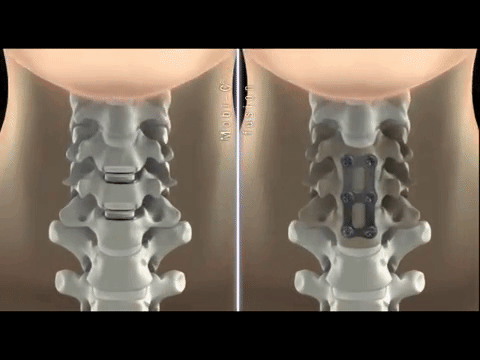 Cervical range of motion in two-level cervical disc replacement versus anterior discectomy and fusion 